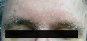 dermatiteseborroica.it - dermatite seborroica alla fronte